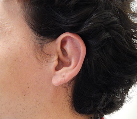 dores-otoplastia