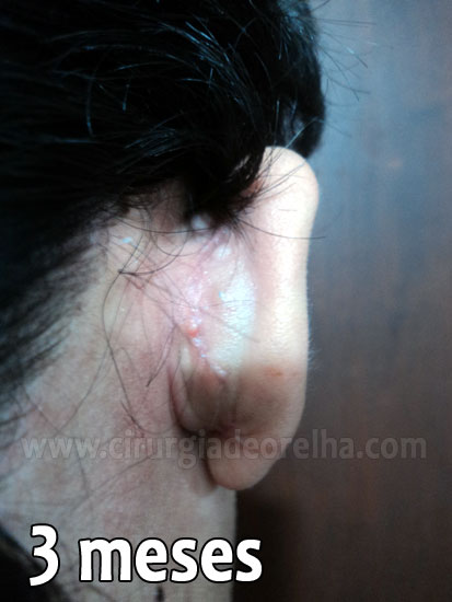 otoplastia-cicatriz-3-meses