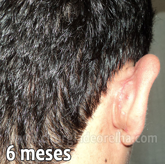 otoplastia-cicatriz-6-meses