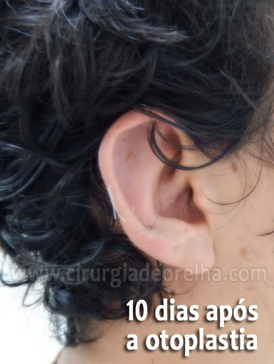 otoplastia-inchaco-10-dias