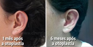 Por que as orelhas ficam muito inchadas depois da otoplastia? | Blog da ...
